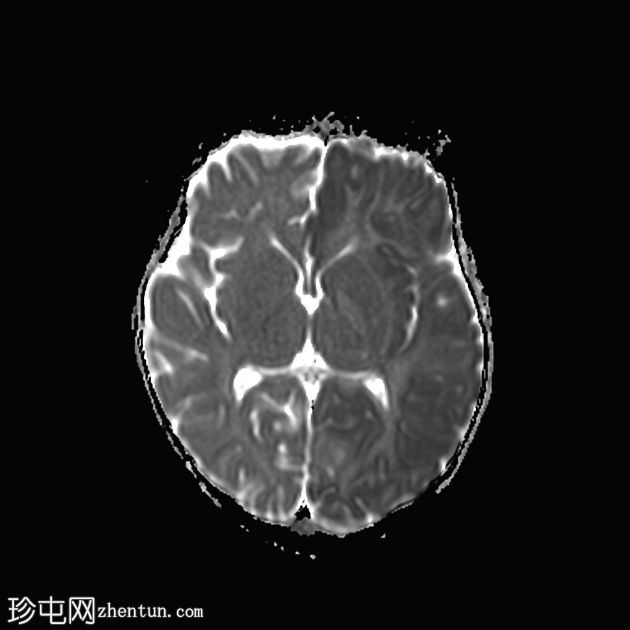 偏瘫-抽搐性癫痫综合征