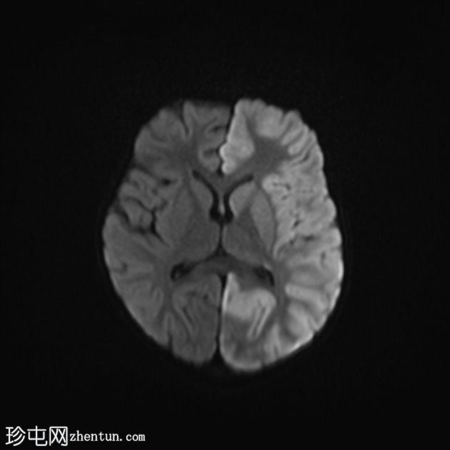 偏瘫-抽搐性癫痫综合征