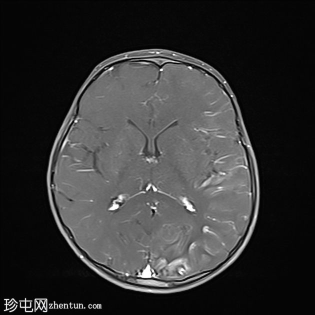 偏瘫-抽搐性癫痫综合征