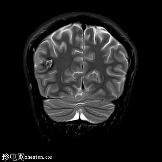 脑海绵状静脉畸形