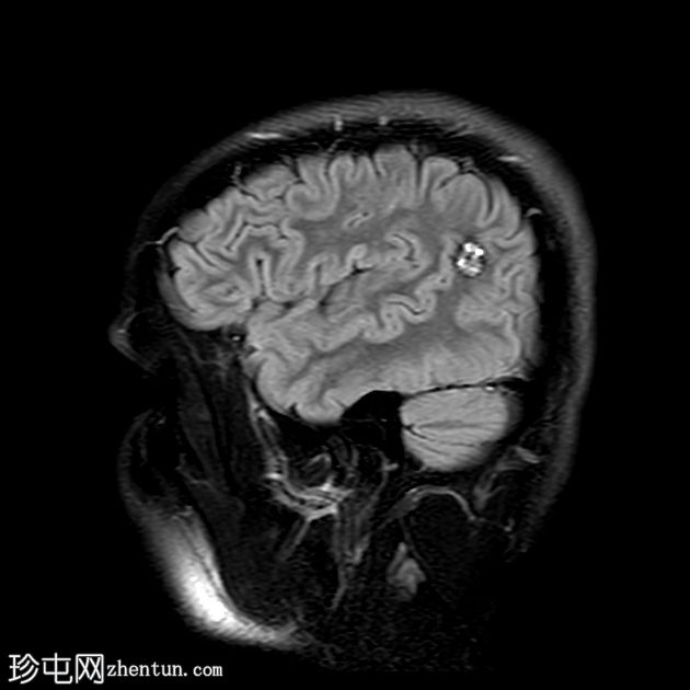 脑海绵状静脉畸形