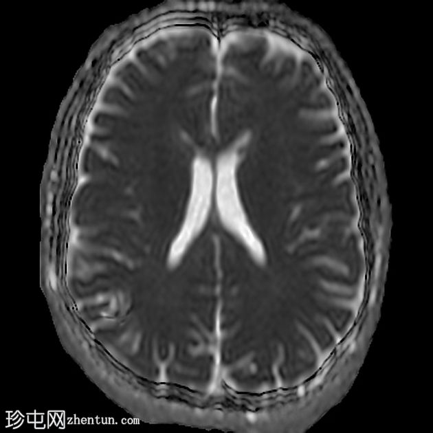 脑海绵状静脉畸形