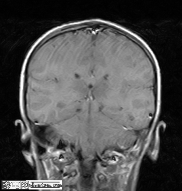 儿童急性坏死性脑炎