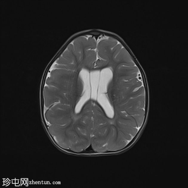 MECP2 重复综合征