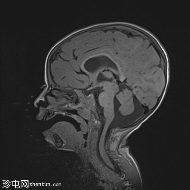 MECP2 重复综合征