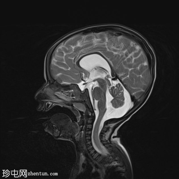 MECP2 重复综合征