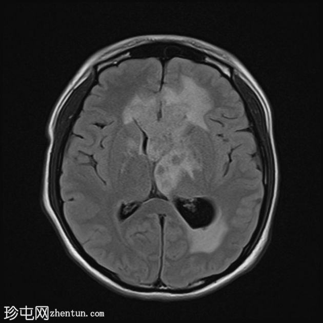 原发性中枢神经系统淋巴瘤