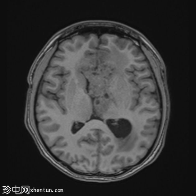 原发性中枢神经系统淋巴瘤