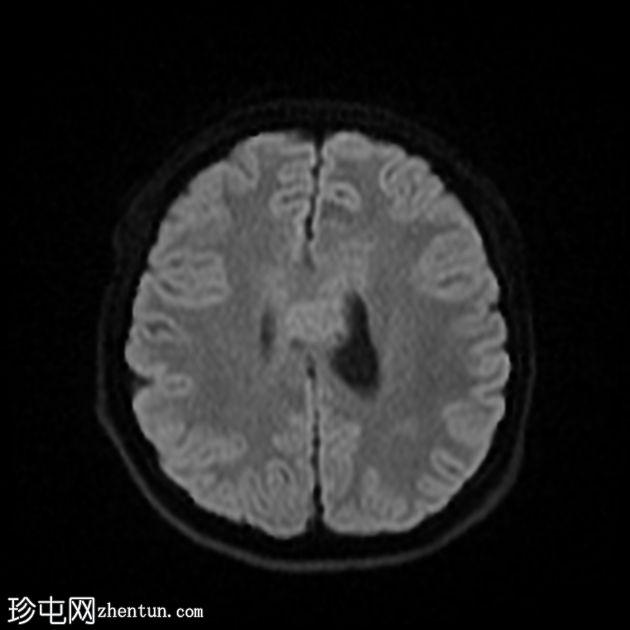 原发性中枢神经系统淋巴瘤