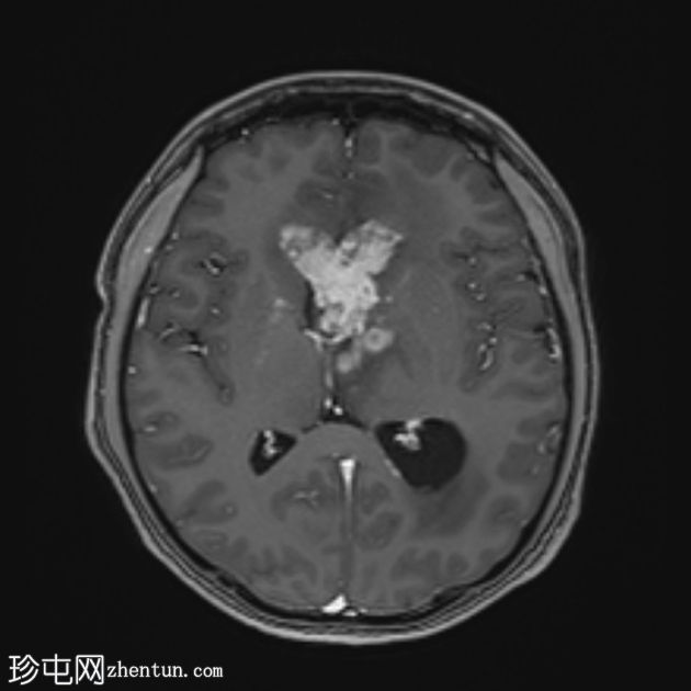 原发性中枢神经系统淋巴瘤