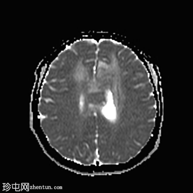 原发性中枢神经系统淋巴瘤