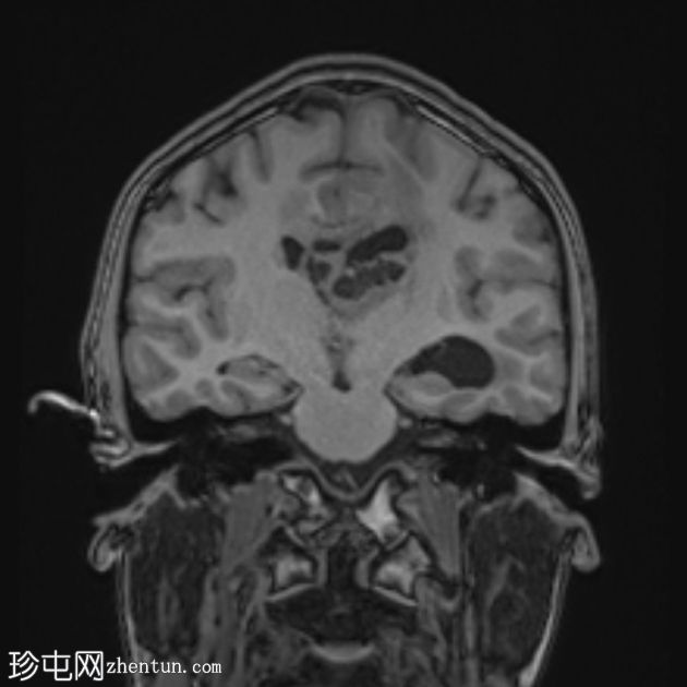 原发性中枢神经系统淋巴瘤