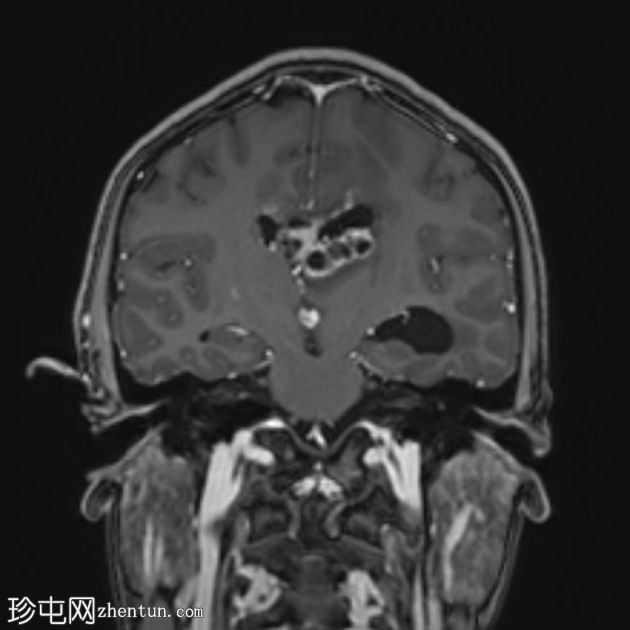 原发性中枢神经系统淋巴瘤