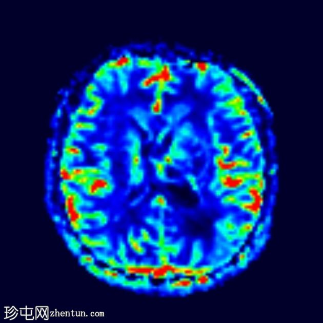 原发性中枢神经系统淋巴瘤