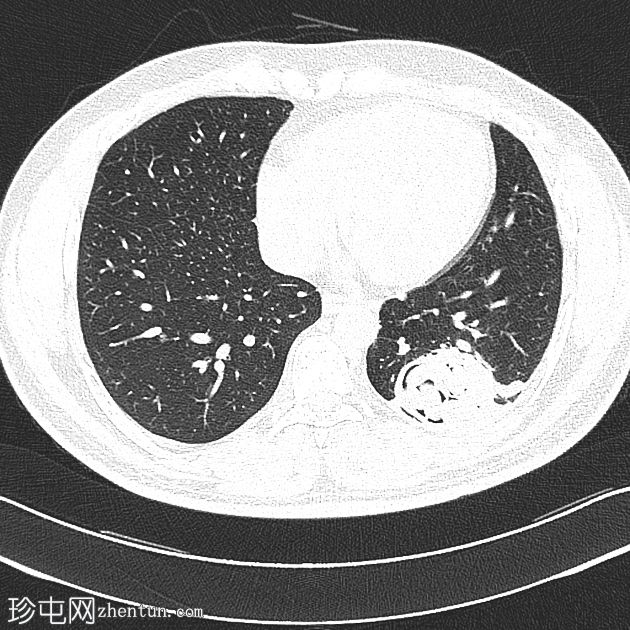 肺包虫感染