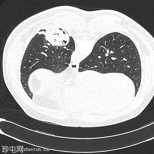 肺包虫感染