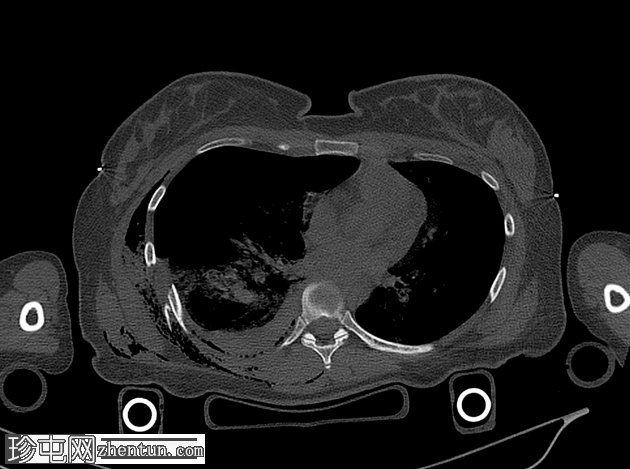 胸部创伤