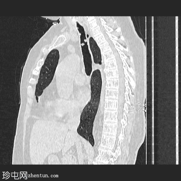 气管支气管乳头状瘤病