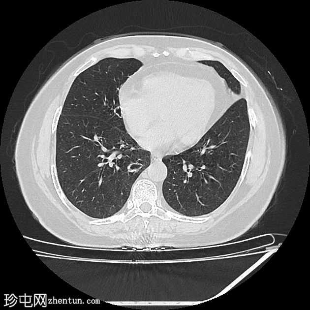 气管支气管乳头状瘤病