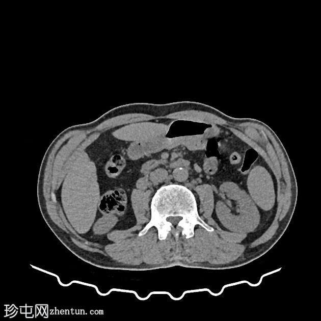 肺气肿伴纤维化