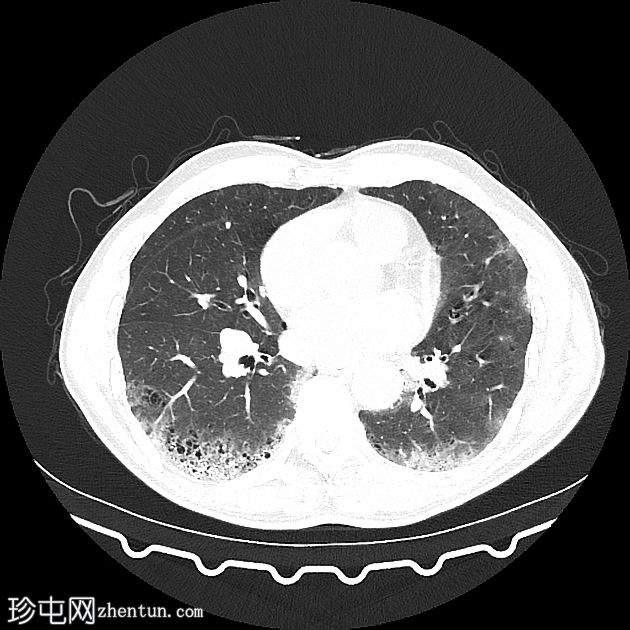 肺气肿伴纤维化