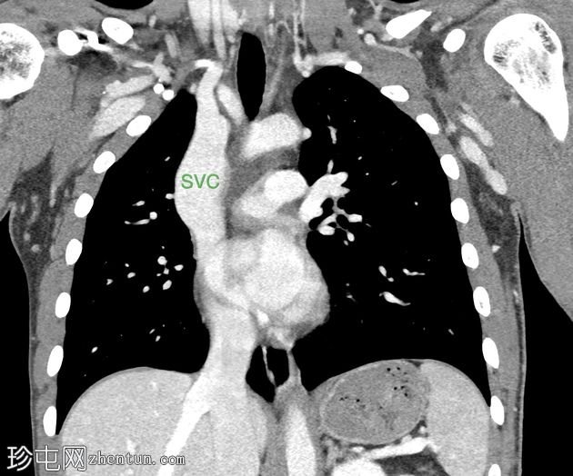 上腔静脉动脉瘤