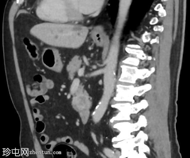 肾细胞癌胰腺转移