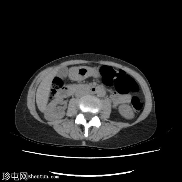 胰腺浆液性囊腺瘤