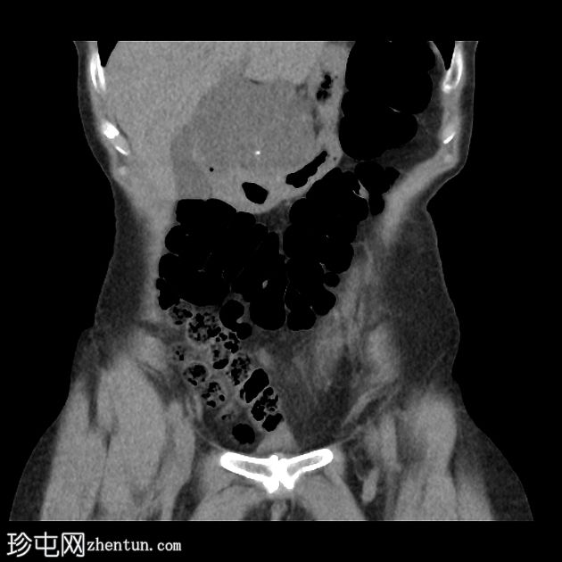 胰腺浆液性囊腺瘤