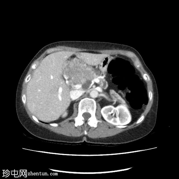 胰腺浆液性囊腺瘤