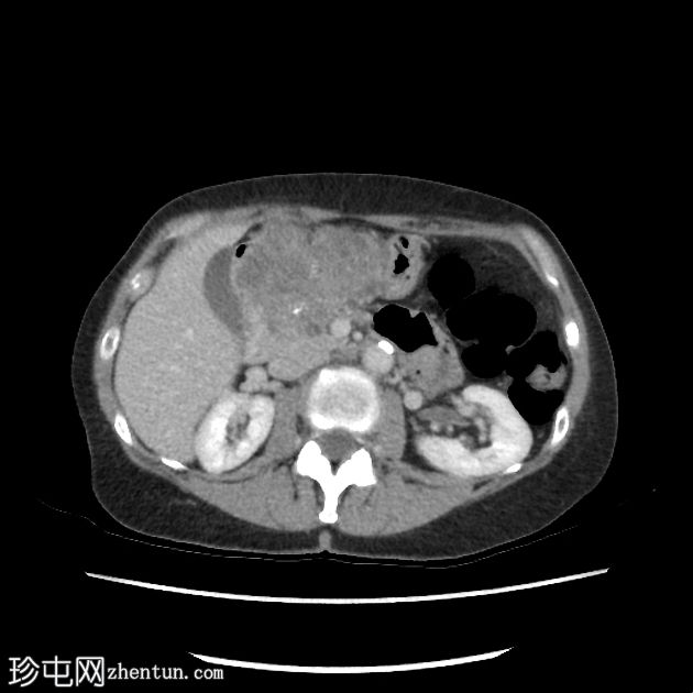 胰腺浆液性囊腺瘤