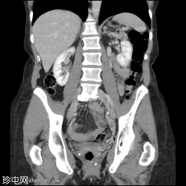 胰腺浆液性囊腺瘤