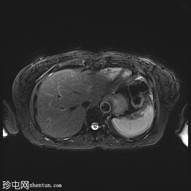 胰腺浆液性囊腺瘤