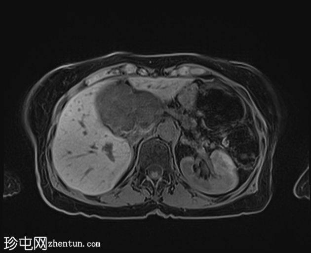 胰腺浆液性囊腺瘤