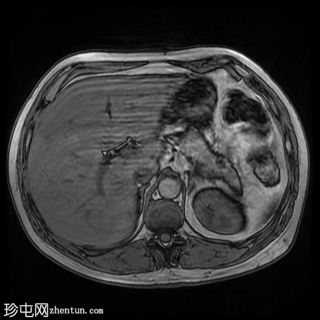 胰腺脂肪瘤