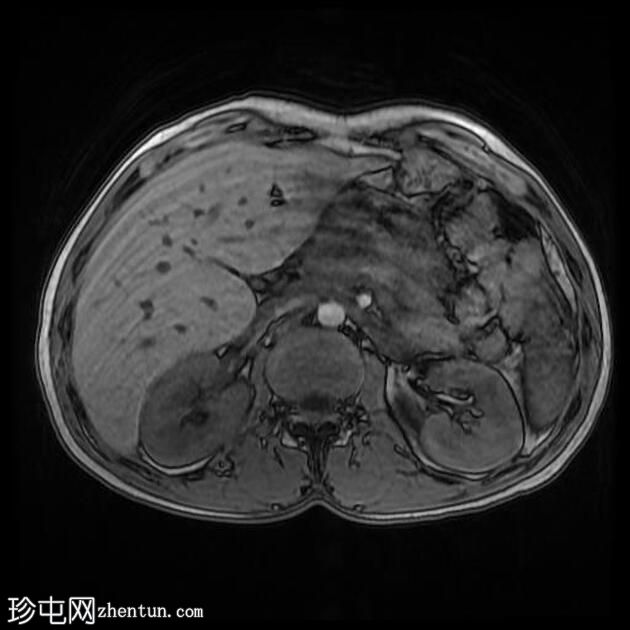 肝包虫囊肿伴胆管内破裂