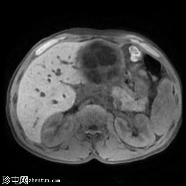 肝包虫囊肿伴胆管内破裂