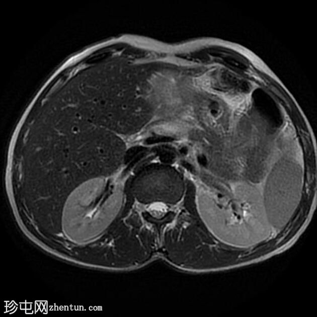 肝包虫囊肿伴胆管内破裂