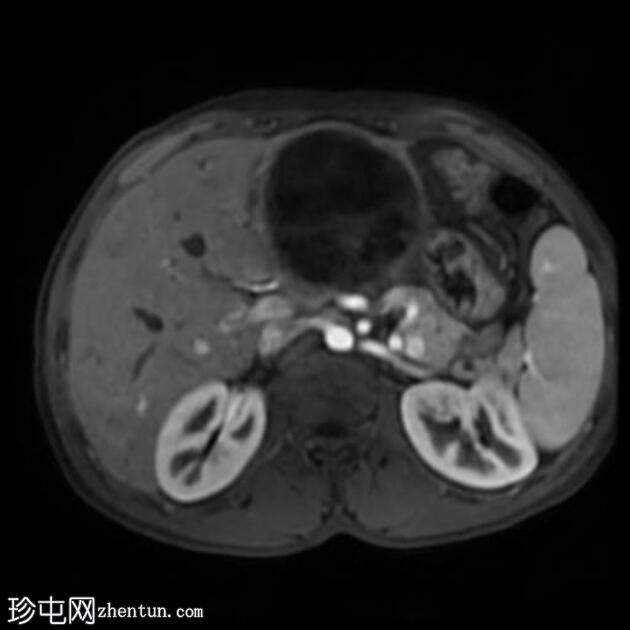 肝包虫囊肿伴胆管内破裂