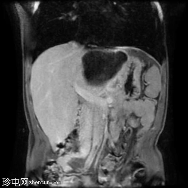 肝包虫囊肿伴胆管内破裂