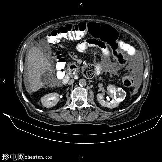 转移性胰腺导管腺癌