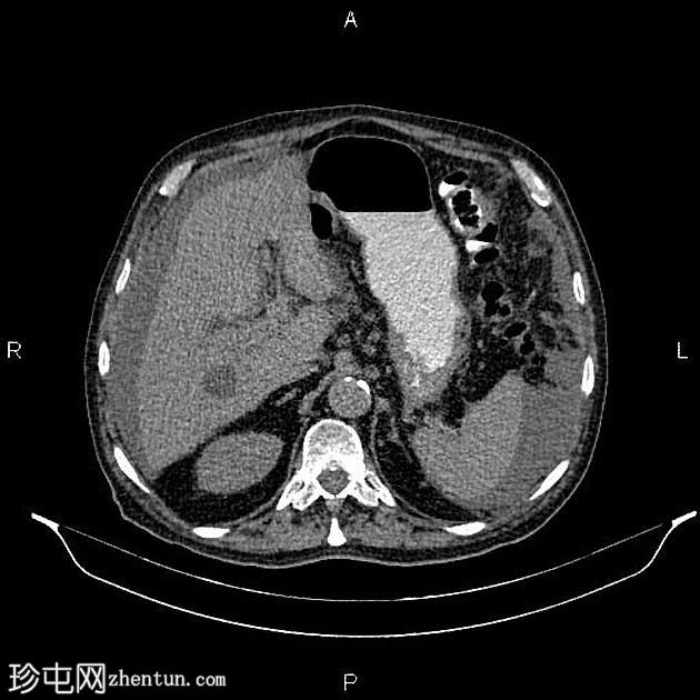 转移性胰腺导管腺癌