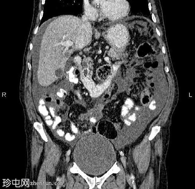 转移性胰腺导管腺癌