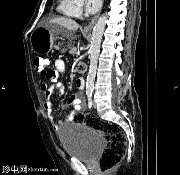 转移性胰腺导管腺癌