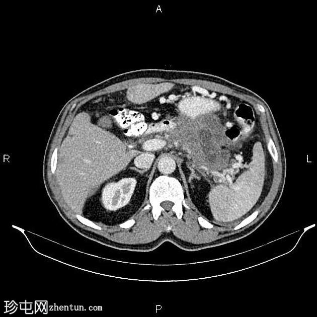 转移性胰腺导管腺癌