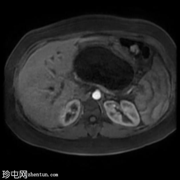 胰腺假性囊肿