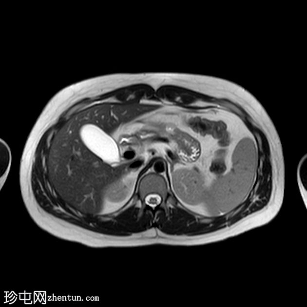 背侧胰腺发育不全