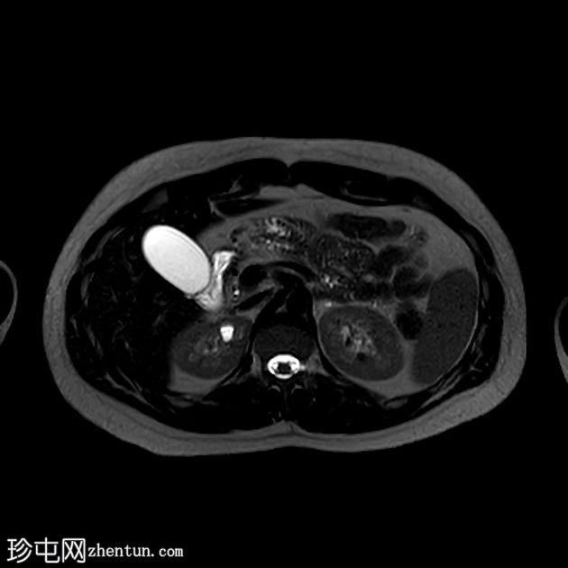 背侧胰腺发育不全