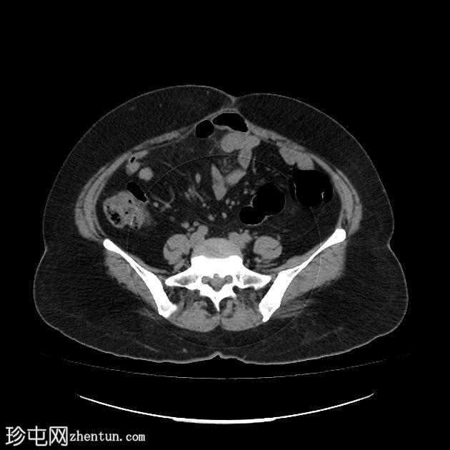 胰腺粘液囊腺瘤