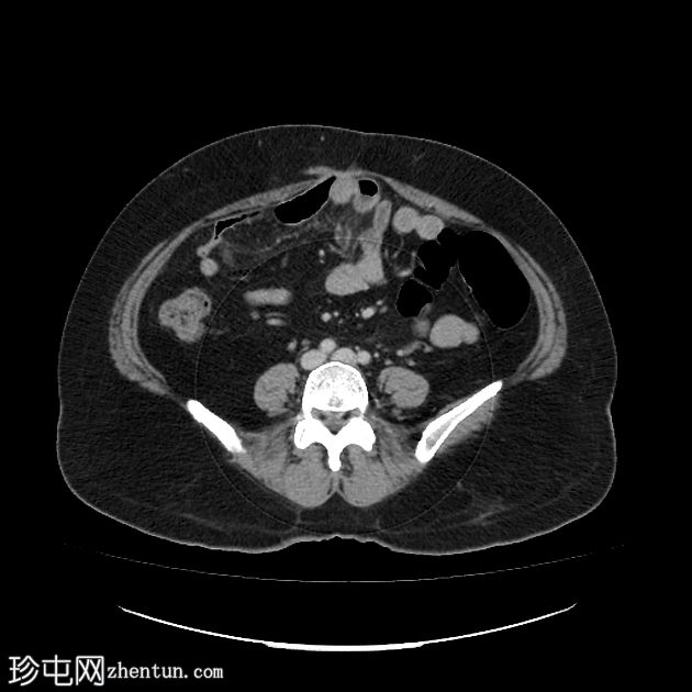 胰腺粘液囊腺瘤